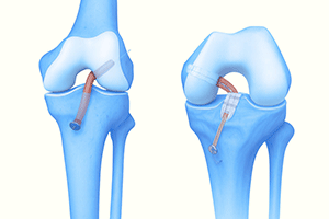 acl reconstruction in the north east and newcastle