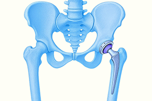 hip replacement in the north east and newcastle