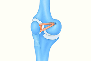 patella stabilisation in the north east and newcastle